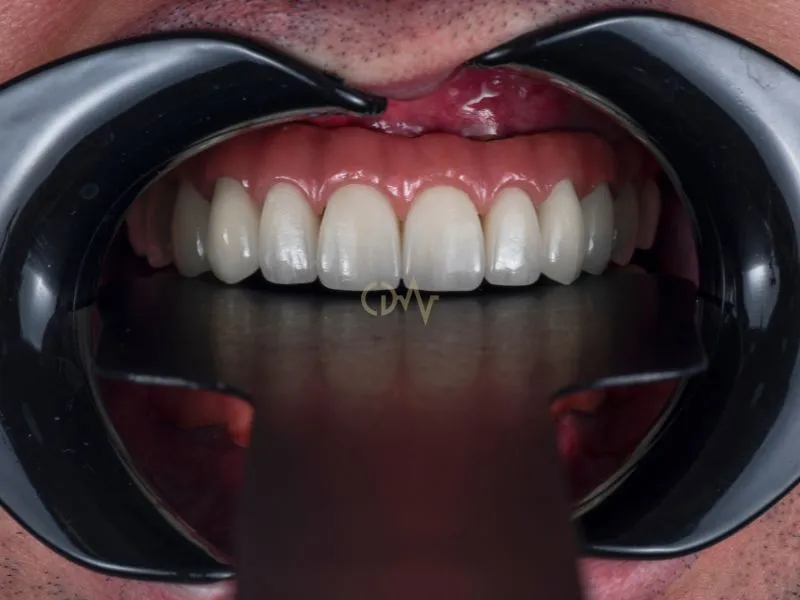 الأطراف الاصطناعية للأسنان 